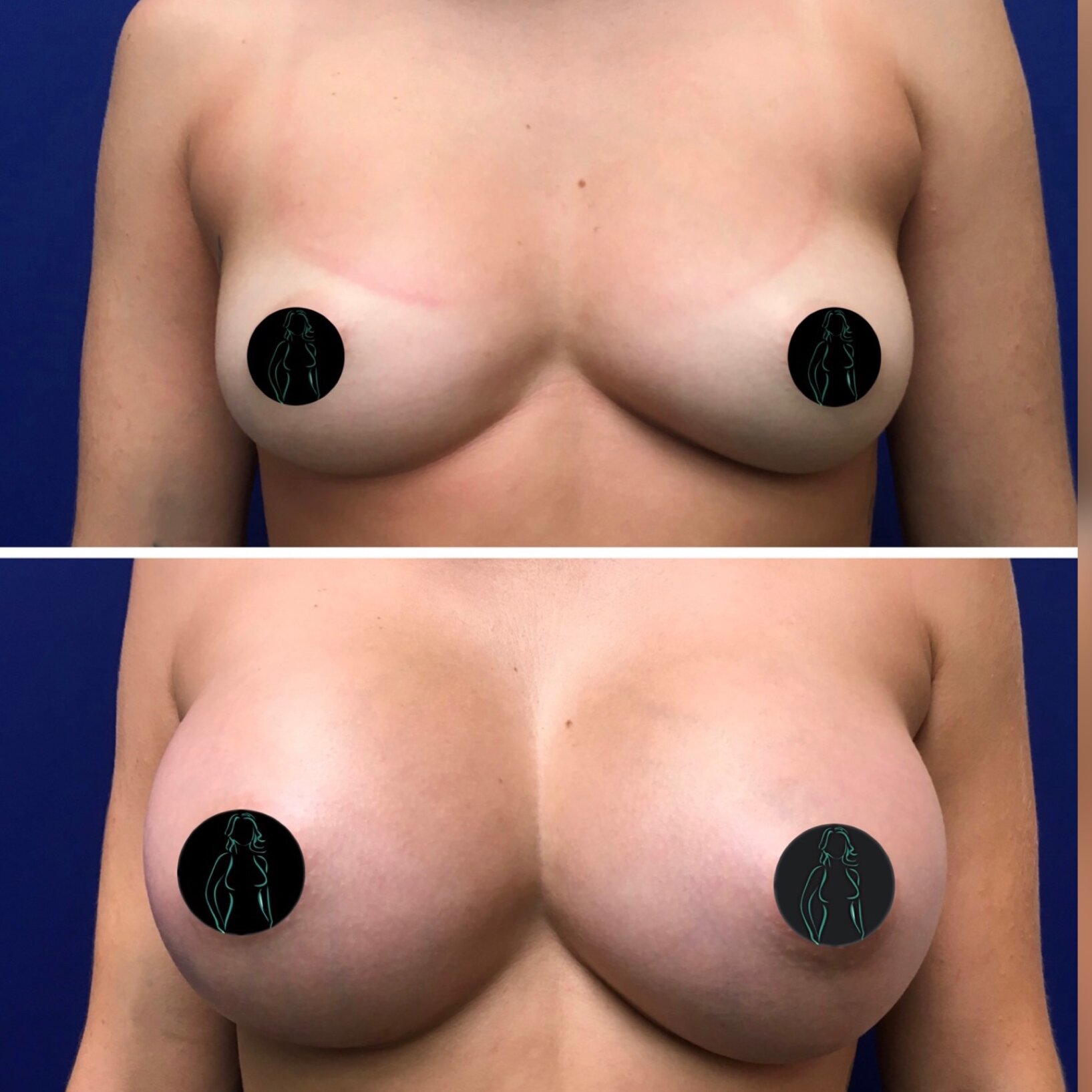 Breast Implant